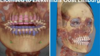 kaakoperatie virtuele chirurgie v3D planning osteotomie [upl. by Enitsugua]