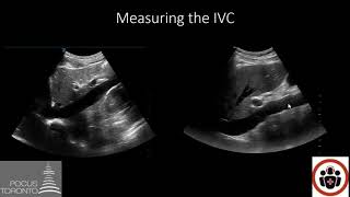 POCUS Cases 4 IVC POCUS for volume status [upl. by Aramahs]