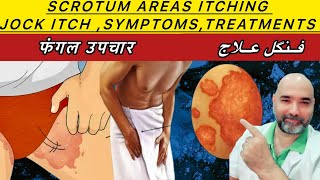 Jock itch scrotum fungal symptoms and treatment urduhindi [upl. by Nawat]