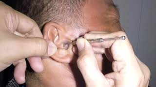 Something MASSIVE Stuck amp Removed From Mans Ear [upl. by Finlay]