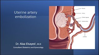 Uterine Artery Embolization UAE [upl. by Holly]