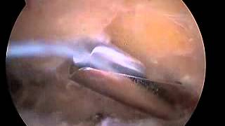 Arthroscopic Subacromial Decompression [upl. by Nelrsa]