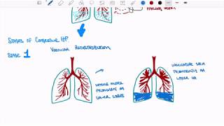 Congestive Heart Failure [upl. by Ainnek]