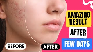 How to Get Rid of Acne Scars Fast This Trick Is a Total Lifesaver [upl. by Dorene]