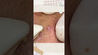 Big Cystic Acne Blackheads Extraction Blackheads amp Milia Whiteheads Removal Pimple Popping shorts [upl. by Enomys]