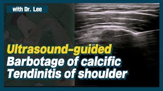 TrailerUltrasoundguided lavage of calcific tendinitis of shoulder ruptured calcification [upl. by Odraode144]