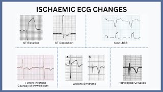 Ischaemic ECG Changes Explained [upl. by Marty553]