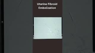 Uterine Fibroid Embolization [upl. by Tiras]