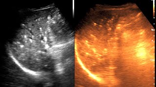 Diffuse Hepatic granuloma  CKD  Ultrasound cases 5 of 2000 [upl. by Sternberg336]