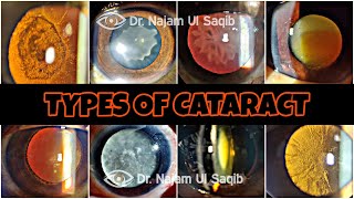 Types Of Cataract [upl. by Sineray]