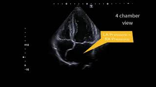 Atrial septal aneurysm [upl. by Finny]