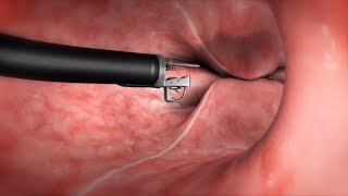 What Happens During the Endoscopic Sleeve Gastroplasty ESG Procedure [upl. by Alleoj611]