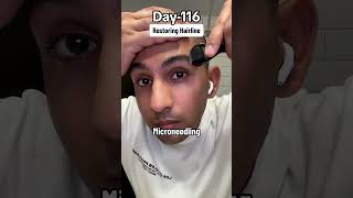 Day116 of Applying Minoxidil Everyday haircare hairloss minoxidil [upl. by Enomaj963]