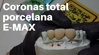 Coronas Dentales EMax TOTAL PORCELANA👅PASOS para CementaciónAdhesión CoronasDentales [upl. by Reltuc]