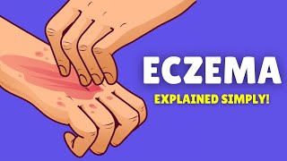 What is Eczema  Causes Signs and Symptoms Diagnosis and Treatment [upl. by Ssur101]