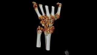 Comminuted distal radius fracture [upl. by Moyers377]