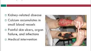 Calciphylaxis  Wound Care Topics  Free Wound Care Info  WoundEducatorscom [upl. by Aicineohp]