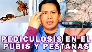 COMO ELIMINAR LA PEDICULOSIS EN EL PUBIS Y PESTAÑAS [upl. by Westfall323]