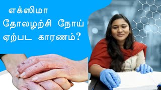 Hand Eczema  எக்ஸிமா தோலழற்சி நோய் ஏற்பட காரணம்DrGayathrirajesh  Tamil [upl. by Cornell]