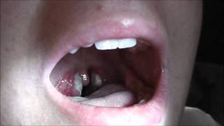 A case of severe tonsillitis [upl. by Robbin372]