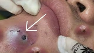 Big Cystic Acne Blackheads Extraction Blackheads amp Milia Whiteheads Removal Pimple Popping 012 [upl. by Natam]