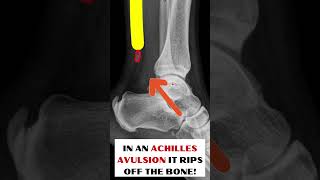 What is an ACHILLES TENDON Avulsion [upl. by Bastien]