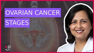 The 4 Stages of Ovarian Cancer by Dr Ruchi Garg [upl. by Sofer]