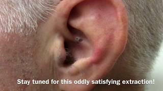 Ear Blackhead Extraction  Dr Steven Greene in Seattle [upl. by Adyl525]