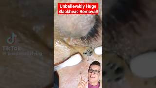 Chaotic BLACKHEAD REMOVAL UNDER EYE This Is Crazy shorts [upl. by Nnaassilem]