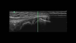 Elbow Ultrasound Intra articular Injection Lateral Approach [upl. by Gagne851]