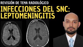 Revisión de Tema 83 Infecciones del sistema nervioso central Leptomeningitis [upl. by Ahsin]