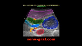 Sonographie  Cholestase bei Pankreaskopf Raumforderung [upl. by Aivuy928]