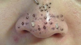 Blackhead Removal With Sac Dep Spa 1000362 [upl. by Kcitrap429]