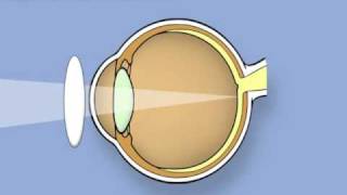 Retinoscopy of the eye Ophthalmology [upl. by Nnylodnewg]