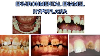 ENVIRONMENTAL ENAMEL HYPOPLASIA  DEVELOPMENT DISTURBANCE IN THE STRUCTURE OF TEETH [upl. by Ynohta]