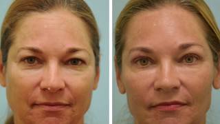 One Week after Upper Blepharoplasty Video and Photos [upl. by Zena]