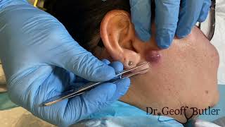 Drainage of an infected cyst in front of the ear [upl. by Eitsim]