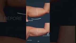 Before and After Video Arm Liposuction Transformation [upl. by Russi99]