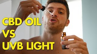 Psoriasis UVB Light Vs CBD Oil  Progress Report [upl. by Allis412]