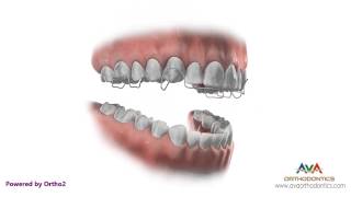 Orthodontic Retainer  Hawley  Instruction and Care [upl. by Redla]