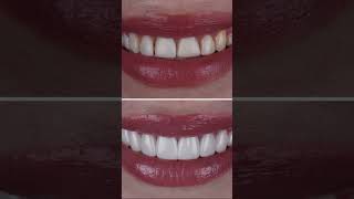 The difference in composite veneers and porcelain veneers [upl. by Eggett]