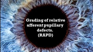 Grading of Relative afferent pupillary defects RAPD [upl. by Inalaehak]