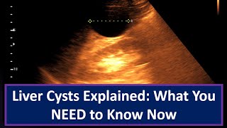 Liver Cysts Explained What You NEED to Know Now [upl. by Servetnick]