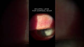 Scleral Lens for Corneal Scar [upl. by Iveson]