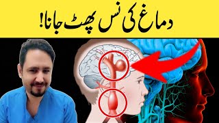 Brain Aneurysm A Silent Killer  Dr Irfan [upl. by Cooley]