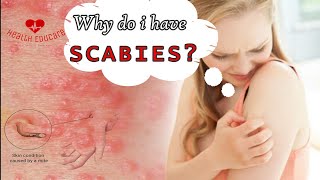 Scabies mites coming out of my skin [upl. by Pudendas]