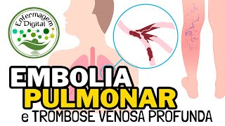 Embolia Pulmonar e Trombose Venosa Profunda  Aprenda a reconhecer suas principais características [upl. by Pedrotti]