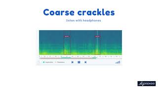 Lung sounds  coarse crackles [upl. by Marjorie143]