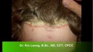 Dr Kin Leung Naturopathic Case Review Patient with Psoriasis Vulgaris plaque silver scales on scalp [upl. by Johnna]