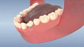 Metal partial denture in lower jaw [upl. by Sumedocin]